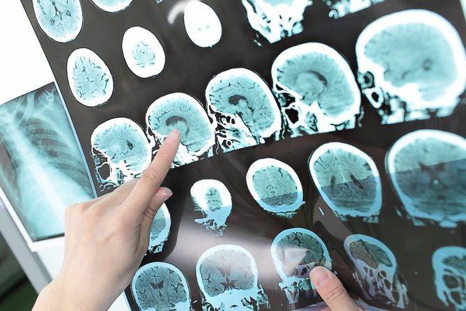 Dzięki lepszemu poznaniu biologii glejaka lekarze są w stanie zaproponować pacjentom skuteczniejsze metody leczenia