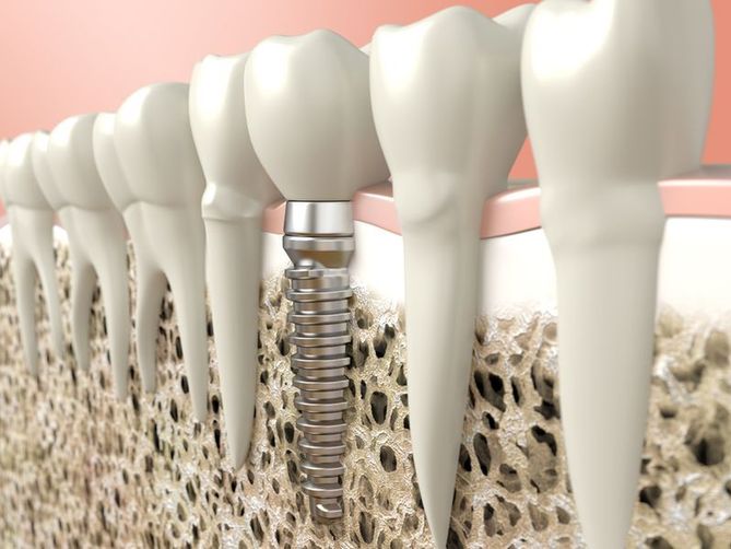 Naukowcy pracują nad nową generacją implantów