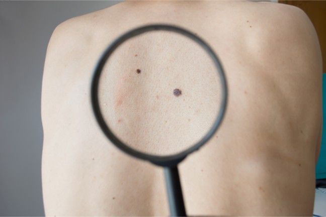 Sztuczna inteligencja będzie jednym z narzędzi, pomagających zdiagnozować raka skóry