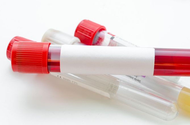 Zespół antyfosfolipidowy polega na zmianie krzepliwości krwi, przez co dochodzi do zatorów i zakrzepów