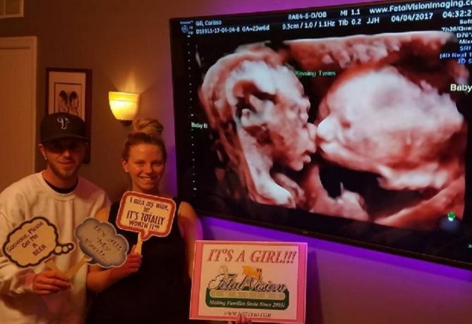 Callie i Randy ze zdjeciem USG 3D bliźniaczek w klinice