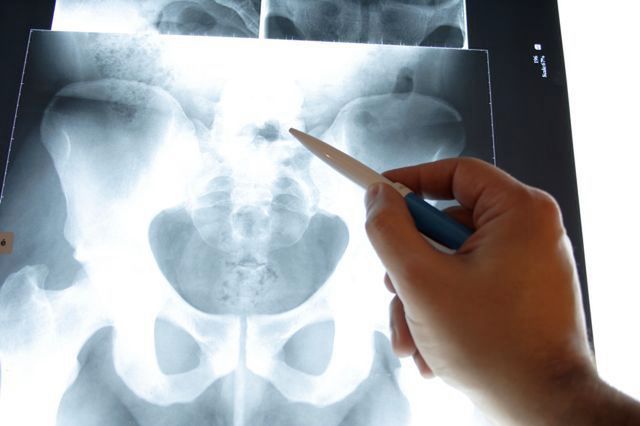 Czy warto stosować wapń na osteoporozę?