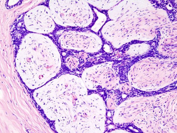 Obraz histopatologiczny fibroadenomii