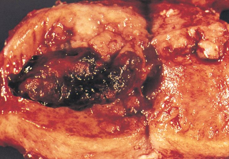 Zdjęcia raka endometrium