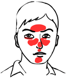 Trądzik różowaty (łac. rosacea)