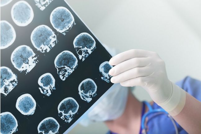 W przypadku udaru mózgu bardzo ważne jest szybkie rozpoczęcie leczenia