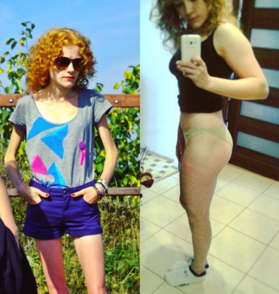 Karolina Dudek - w czasie i po walce z anoreksja
