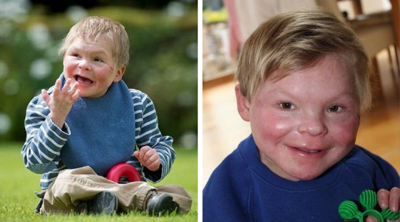 Angus jest pierwszym na świecie dzieckiem, u którego zdiagnozowano takie zaburzenie chromosomów