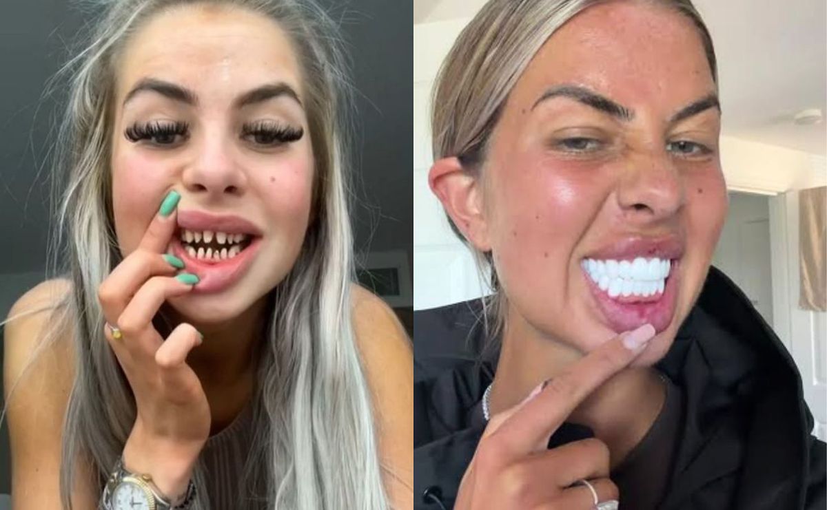 Polish surgeon warns against "Turkish teeth": risk of permanent disfigurement