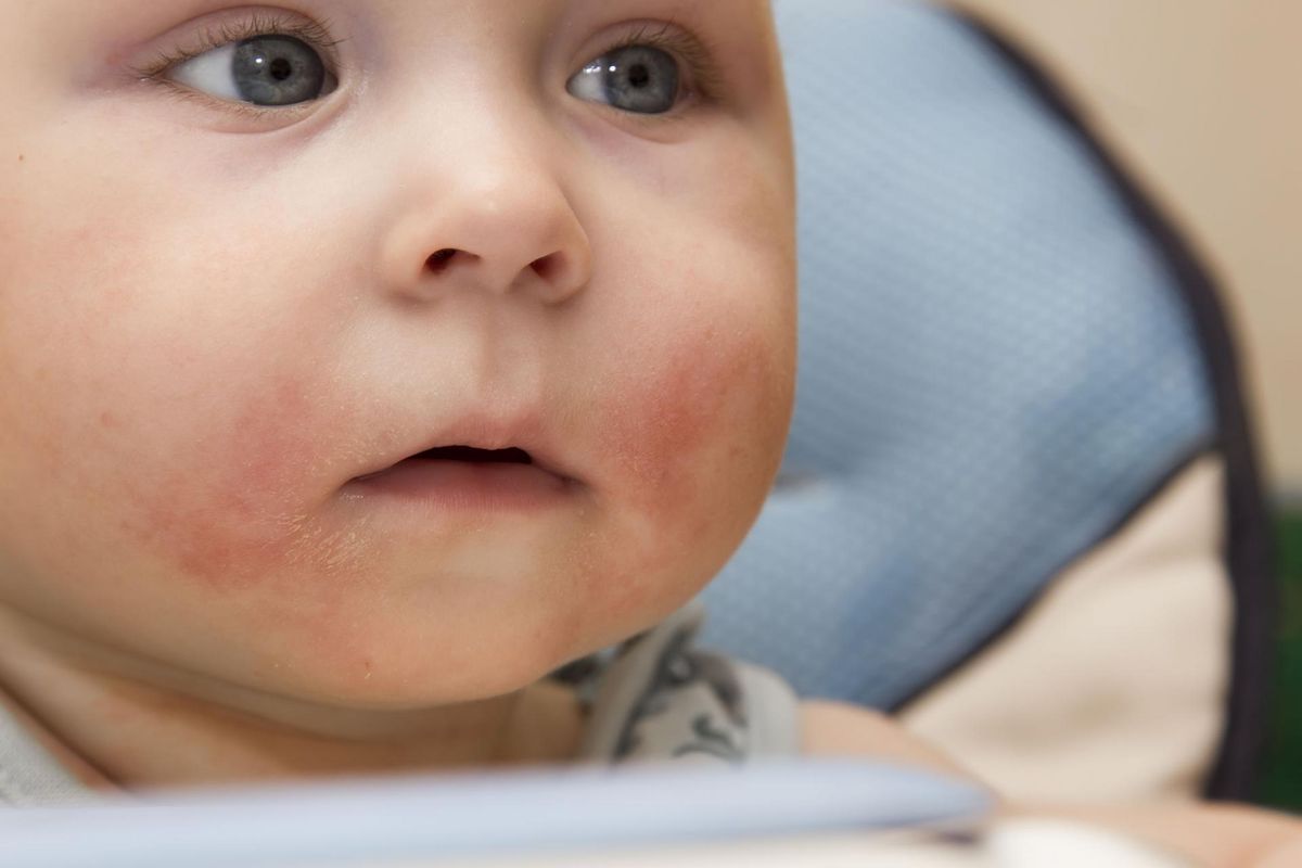 Alergia Pokarmowa U Dzieci Przyczyny Nietolerancja Reakcje Alergiczne Diagnoza I Leczenie Wp Parenting