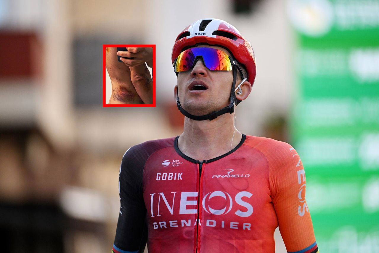 "Boli jak diabli". Kwiatkowski pokazał, jak wygląda jego ciało po wypadku