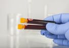 Biochemia krwi -  profile oznaczeń, normy