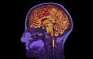 Co warto wiedzieć o udarze mózgu?