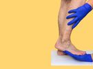 Pajączki na nogach - przyczyny, objawy i leczenie. Domowe sposoby na pękające naczynka