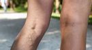 Objawy zakrzepicy - opuchlizna nóg, pajączki, podwyższona temperatura, rozgrzana skóra
