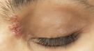 Półpasiec oczny - objawy, leczenie i powikłania