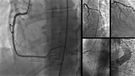 Przyczyny i objawy tętniaka serca. Sprawdź, co powinno niepokoić (WIDEO)