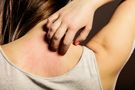 Alergiczne kontaktowe zapalenie skóry - charakterystyka, czynniki ryzyka