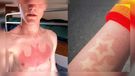 Niebezpieczny letni trend - tatuaże słoneczne