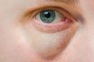Choroby, które objawiają się workami pod oczami. Sprawdzone sposoby na worki pod oczami