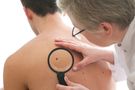 Objawy i rodzaje czerniaka - jak rozpoznać nowotwór skóry?