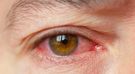 Koronawirus powoduje przekrwienie oczu? Objawem Covid-19 może być zapalenie spojówek