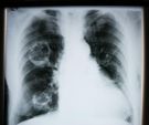Lekarz wyjaśnia, jak koronawirus niszczy płuca. Zmiany występują nawet u pacjentów, którzy ozdrowieli