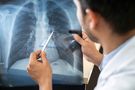 Jak koronawirus niszczy płuca? Przełomowe badania włoskich naukowców. Autopsje uratowały tysiące osób