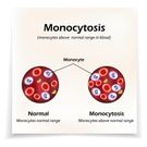 Monocytoza - przyczyny, diagnostyka i leczenie