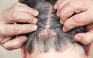 Swędząca skóra głowy. 5 nieoczywistych przyczyn problemu
