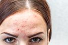 Trądzik pospolity (acne vulgaris) - charakterystyka, klasyfikacja, przyczyny, objawy, leczenie, rokowanie