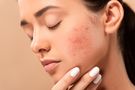 Ziarniniak kwasochłonny twarzy - przyczyny, objawy i leczenie