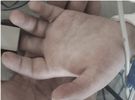 Sine dłonie mogą być objawem COVID-19