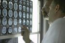 Nieznana choroba atakuje mózg młodych osób. Lekarze i naukowcy są bezradni 