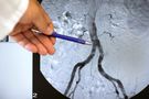 Choroby aorty - wrodzone i nabyte. Czy są groźne?
