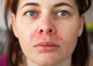 Gronkowiec w nosie - objawy, rozpoznanie i leczenie
