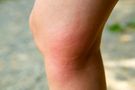 Rumień alergiczny - przyczyny, objawy, sposoby leczenia