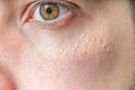 Białe kropki pod oczami - przyczyny i leczenie