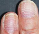Charakterystyczne zmiany na paznokciach. Świadczą o raku żołądka