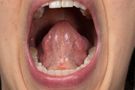 Jama ustna - budowa, choroby, grzybica jamy ustnej