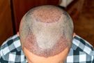 Przeszczep włosów - techniki, przebieg, przeciwwskazania i skutki uboczne