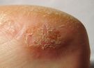 Alergiczne kontaktowe zapalenie skóry na stopie