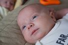 Trądzik niemowlęcy - charakterystyka, przyczyny, objawy i leczenie