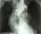 Tętniak rozwarstwiający aorty - zdjęcia