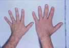 Akromegalia dłoni