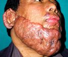 Keloid u mężczyzny po oparzeniu twarzy