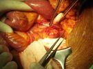 Operacja tętniaka aorty