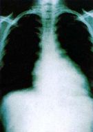 Obraz RTG klatki piersiowej pacjenta z chorobą Chagasa