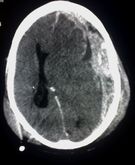 Tomografia głowy u pacjenta z krwiakiem podtwardówkowym