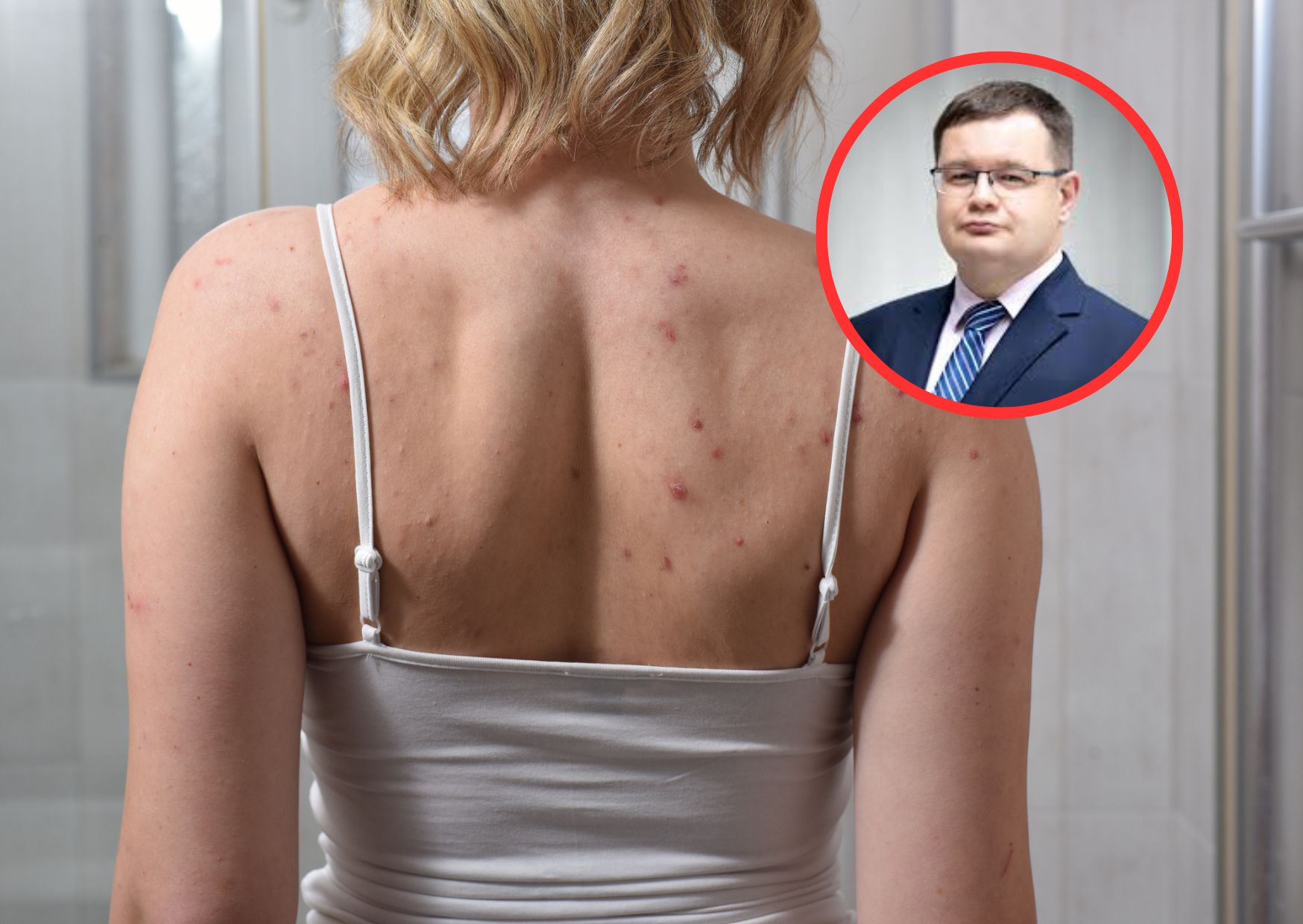 Brodawki mogą rozsiać się po ciele